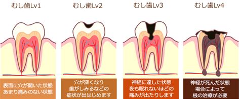 虫歯・歯周病予防 元住吉の歯医者・歯科｜チェルシーデンタルクリニック