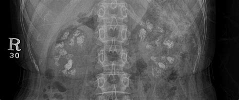 Medullary Nephrocalcinosis Image