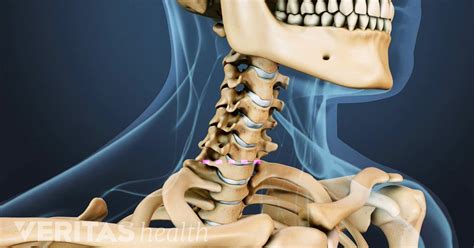 Surgical Procedure for Cervical Disc Replacement