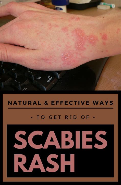 Natural Effective Ways To Get Rid Of Scabies Rash Beauty Org