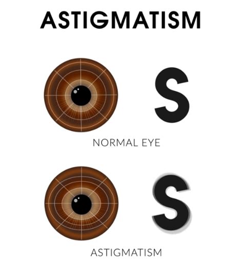 astigmatism symptoms  treatment lions eye institute