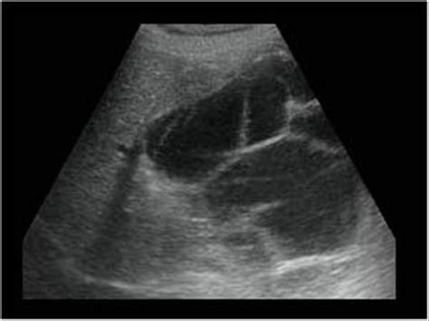 Abdomen And Retroperitoneum Liver Case Hydatid Cysts