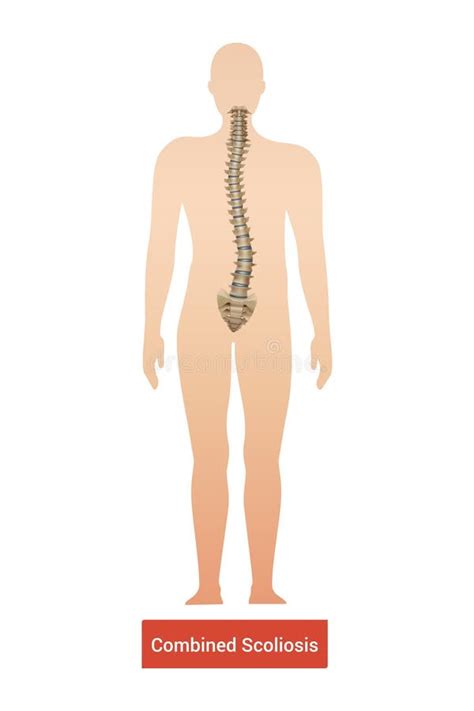 Conjunto Realista De Escoliosis De Columna Ilustración del Vector