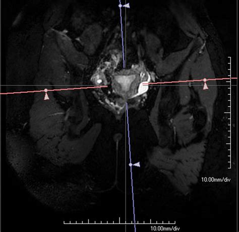 Imaging Of Müllerian Duct Anomalies Radiographics