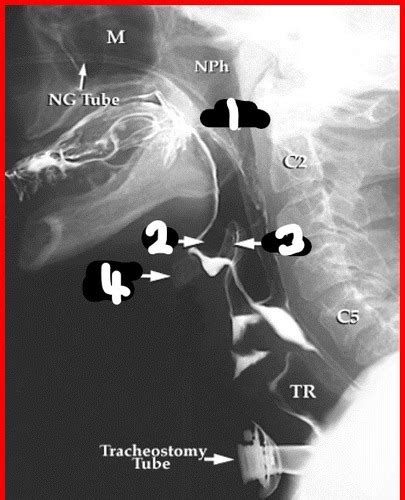 Lateral Neck Xray Flashcards Quizlet