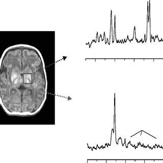 A H Mr Spectrum From Left Basal Ganglia Showing Appreciably Raised