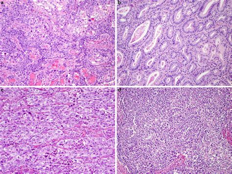 Histology And β Catenin Immunostaining Of Adenocarcinomas Of The