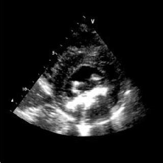 Transthoracic Parasternal Short Axis View At The Level Of The Mitral