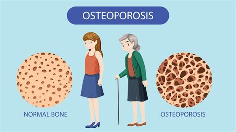 Free Vector Bone Density And Osteoporosis Vector