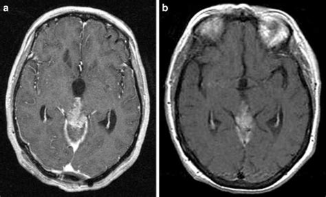 Pineal Region Tumors Radiology Key