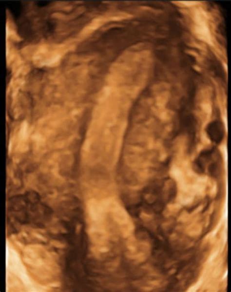 Unicornuate Uterus Radiology Reference Article Radiopaedia Org