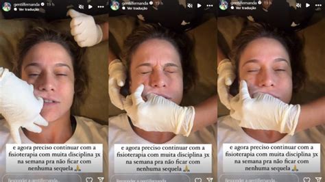 Fernanda Gentil Mostra Tratamento Para Conter Paralisia De Bell