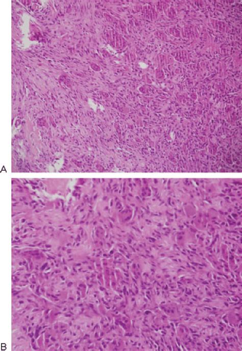 A Histopathology Showing The Giant Cell Tumor B Highpower Field Of