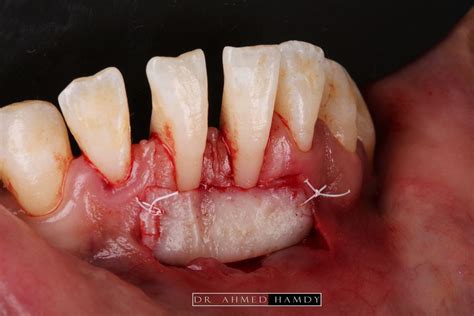 free gingival graft