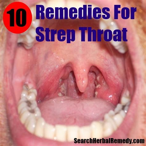 10 Herbal Remedies for Strep Throat - Strep Throat Treatment | Search Herbal & Home Remedy