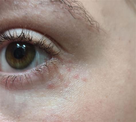 Hi Can You Please Help Me With This I Have This Red Spots Almost Always Under My Left Eye Do