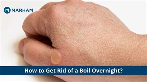 Cool Tips About How To Get Rid Of A Boil Dancelocation19