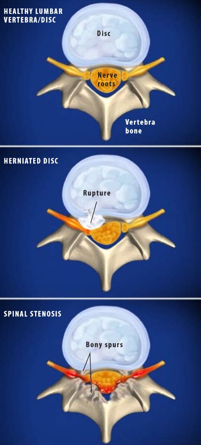 What Is Lumbar Radiculopathy Treatment