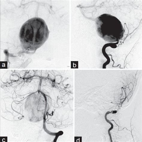 Right Vertebral Angiography Demonstrates A Giant Vertebral Artery