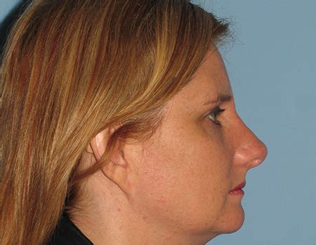 Cleveland Facelift Before After Photos Dr Paul Vanek Md