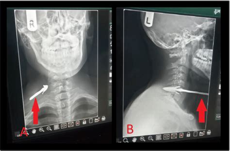 X Ray Of The Neck A Anteroposterior View Showing The Arrow Heading Download Scientific