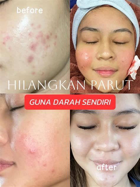 Treatment Untuk Hilangkan Parut Sakit Ke Galeri Disiarkan Oleh