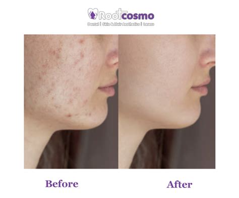 Microneedling MNRF Treatment At RootCosmo Cosmetology Clinic