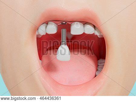 Human Incisor Tooth Image Photo Free Trial Bigstock