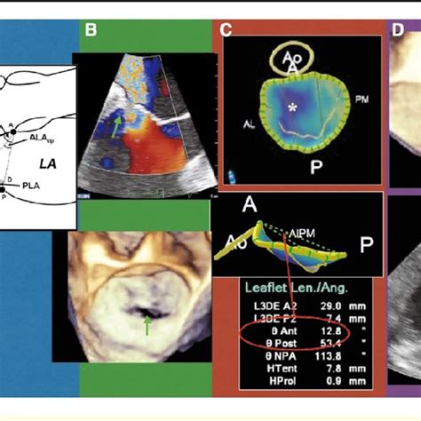 Pdf Quantification Of Mitral Valve Morphology With Three Dimensional