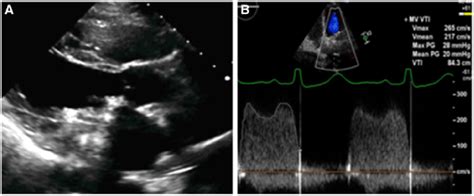 A Parasternal Long Axis Plax In Transthoracic Echocardiography The