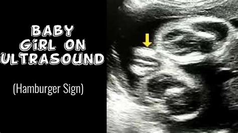 Baby Girl on Ultrasound | Female Baby | Hamburger Sign | Gender Identification - YouTube