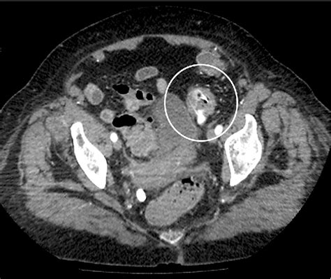 Diverticulosis Of Sigmoid Semantic Scholar