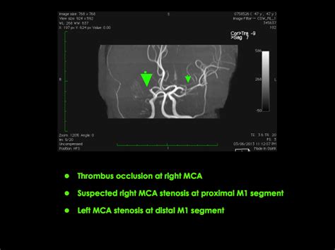 The Hong Kong Minimally Invasive Brain And Spine Neurosurgery Centre Emergency Stroke Care