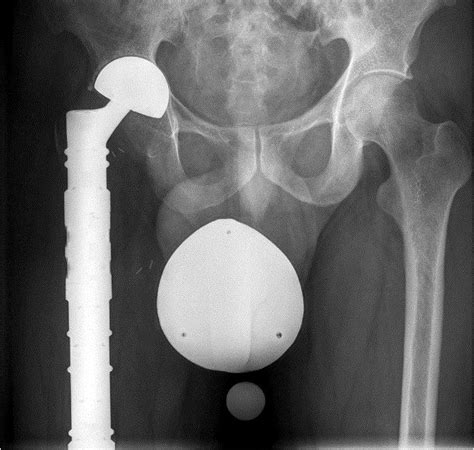 Acetabular Erosion After Bipolar Hemiarthroplasty In Proximal Femoral