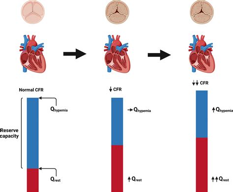 Ecg In Left Ventricular Hypertrophy Lvh Criteria And 53 Off