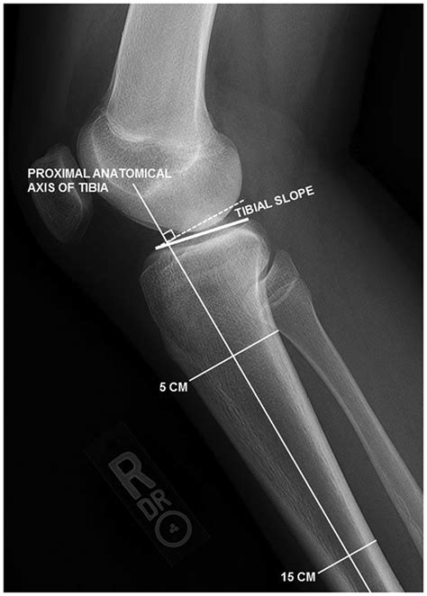 Tibia Posterior View