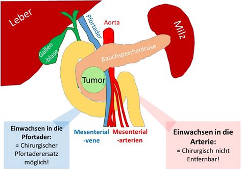 Bauchspeicheldr Senkrebs Pankreaskarzinom Antireflux Info