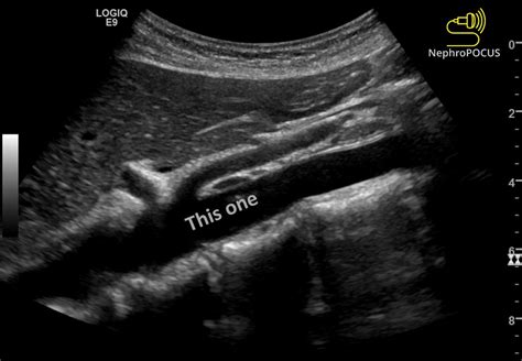 NephroPOCUS On Twitter POCUS Answer This Simple Quiz Got