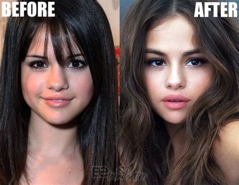 Selena Gomez Plastic Surgery Revealed! Before and After