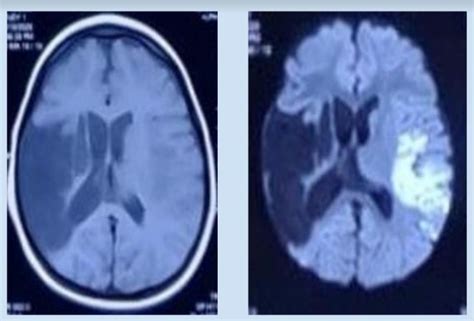 MRI scan showed large right MCA territory encephalomalacia on T1WI ...