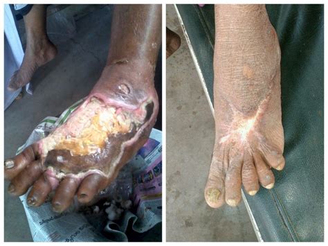 Treatment For Gangrene MEDizzy