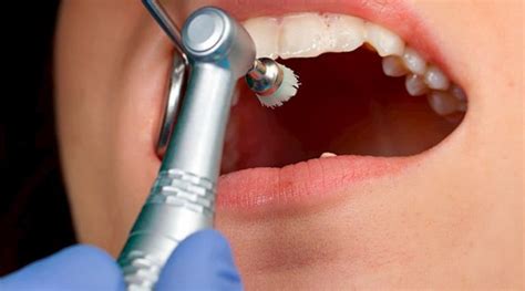 Profilaxis Dental Limpieza Dental Cl Nica Dental Tacna