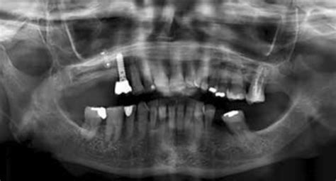 Minimally Invasive Class Ii Restoration Of An Upper Premolar A