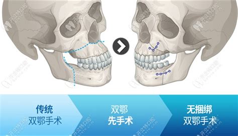 正颌手术包含凸嘴和双鄂手术 区别方法和参考费用在这里 前沿技术 开立特口腔