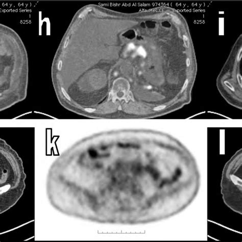 A Year Old Male Patient With Pathologically Proven Metastatic Rcc