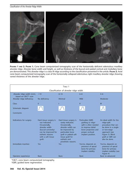 Classification Of Alveolar Bone Width PDF