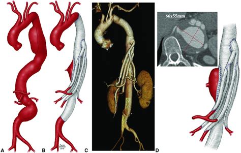 Illustration Showing An Extent Ii Postdissection Thoracoabdominal