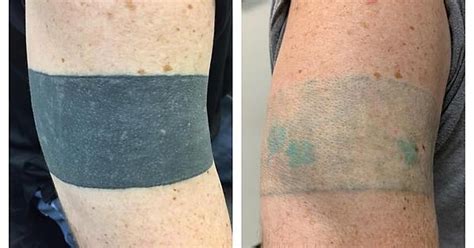 Blackout Tattoo Removal Album On Imgur