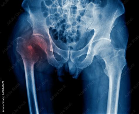 x-ray hip fracture of old man, x-ray image intertrochanteric fracture ...