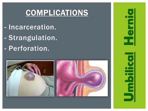 Umbilical hernia | PPT